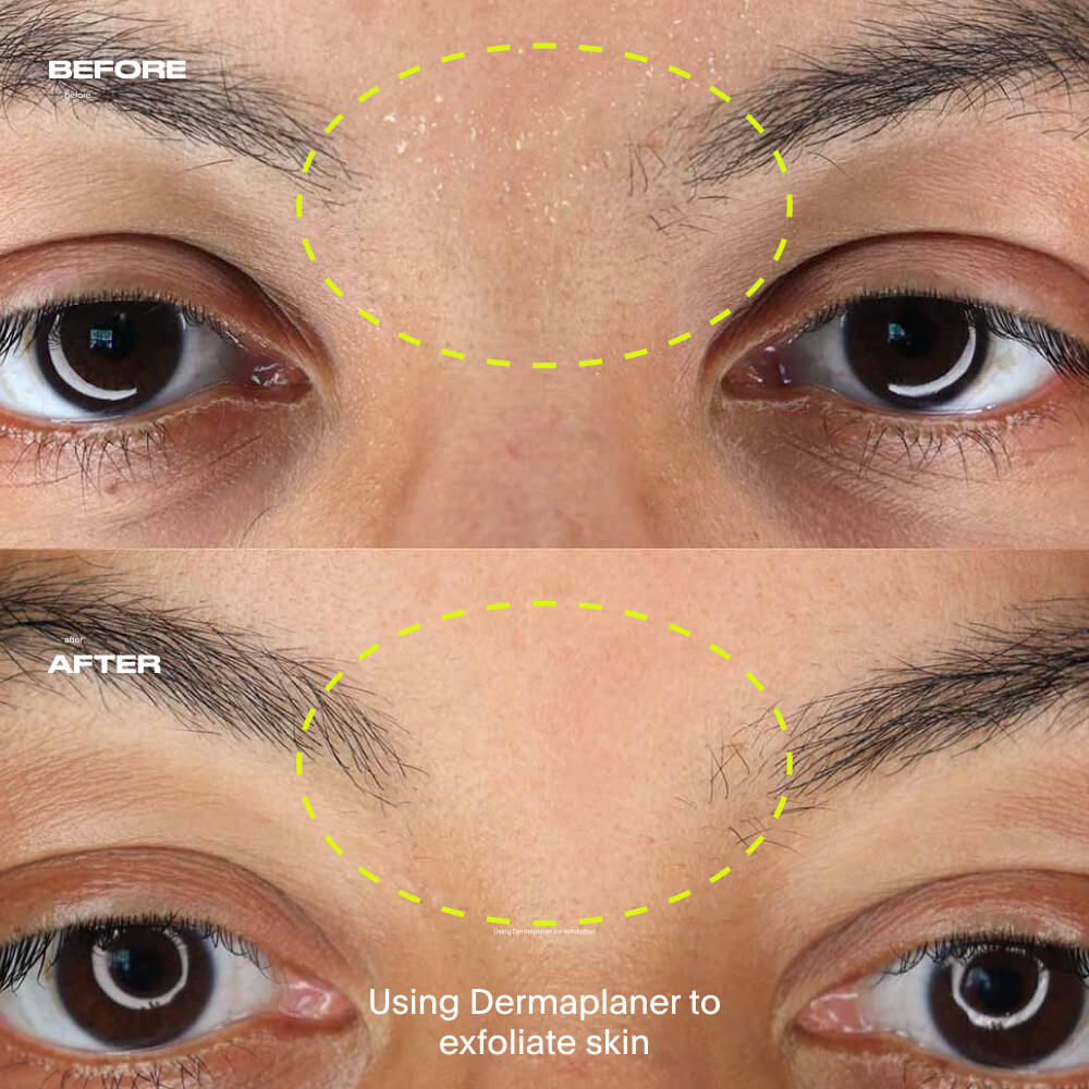 Dermaplaner, Gold